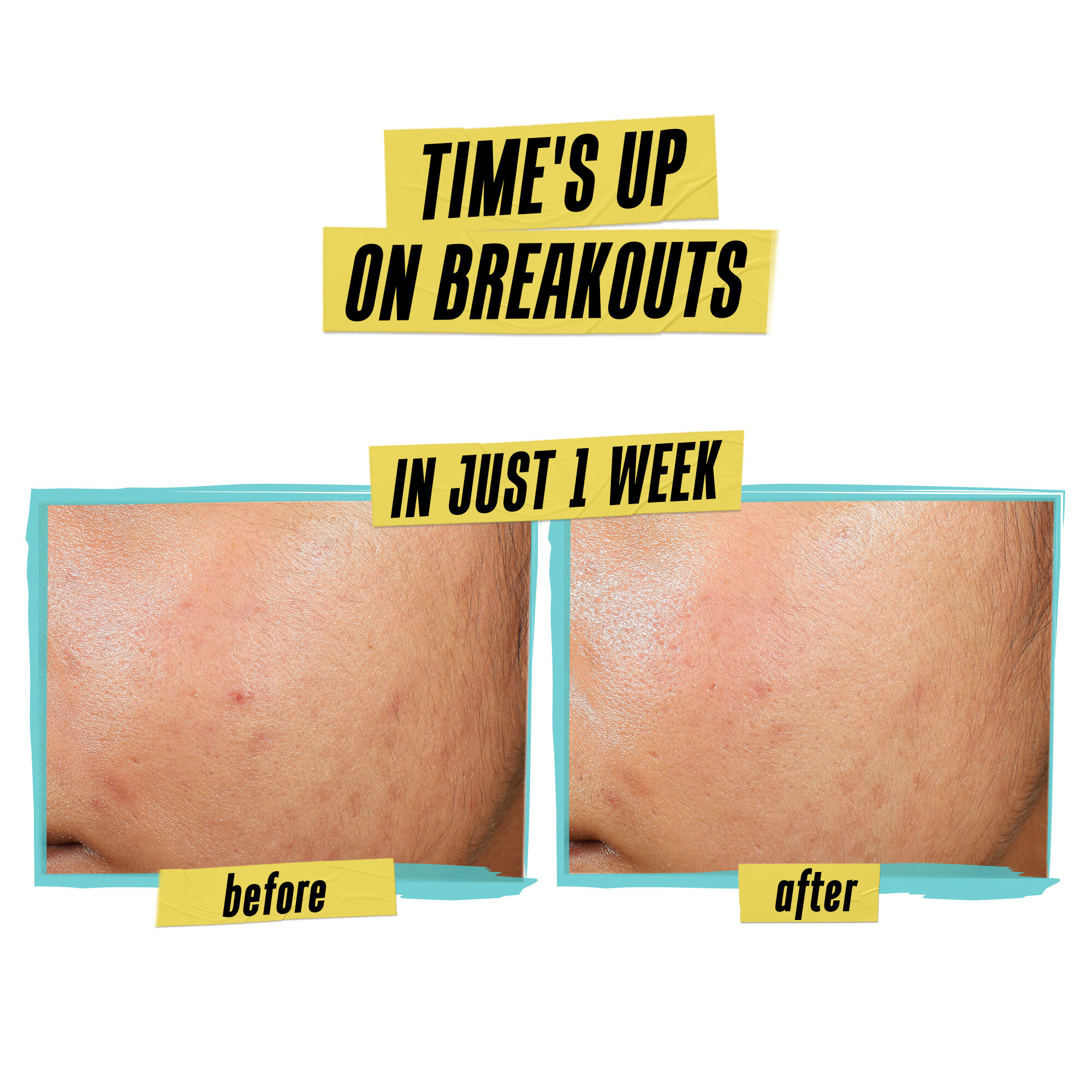 مرطب منقي خاص للبشرة المعرضة لحب الشباب مع حمض الساليسيليك